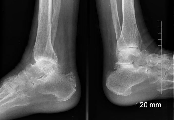 imagerie_pathologie_arriere_pied - ARTHROSE DE L'ARTICULATION SOUS-TALIENNE